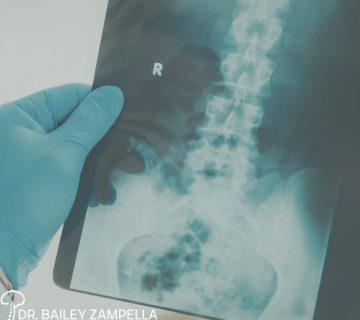 A gloved hand holds a spinal X ray film showing the lumbar region, labeled with an "R"; branding at the bottom reads "Dr  Bailey Zampella Neurosurgery 